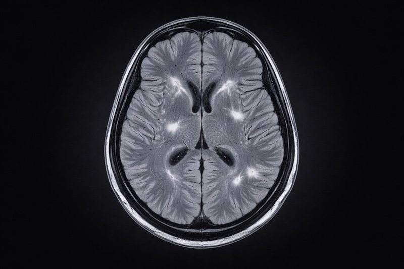 irm-cerveau-lesions Image IRM du cerveau en noir et blanc montrant des lésions visibles, utilisée à des fins éducatives et explicatives.