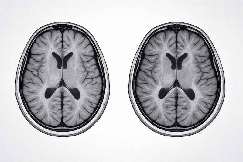 irm-cerveau-comparaison-sclerose-en-plaques Deux images IRM du cerveau présentées côte à côte pour illustrer une comparaison dans le suivi de la sclérose en plaques.